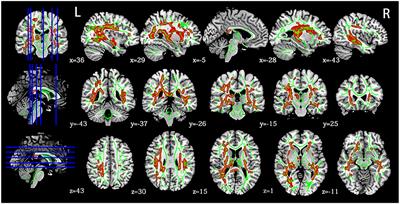 Early Changes in the White Matter Microstructure and Connectome Underlie Cognitive Deficit and Depression Symptoms After Mild Traumatic Brain Injury